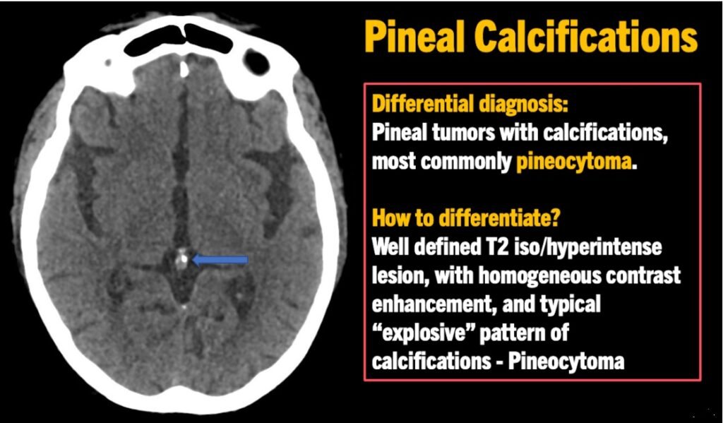 Calcified Pineal Gland